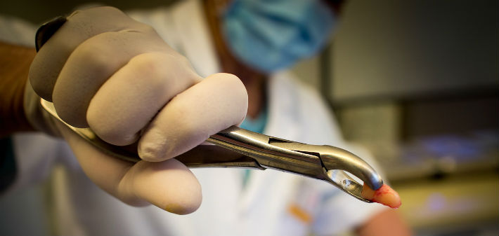A male dentist's gloved hand holds extracting forceps, a recently removed tooth gripped by the business end.