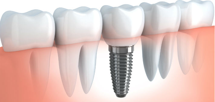 Diagram of a dental implant is identical to the four surrounding teeth and screws permanently into the gumline.