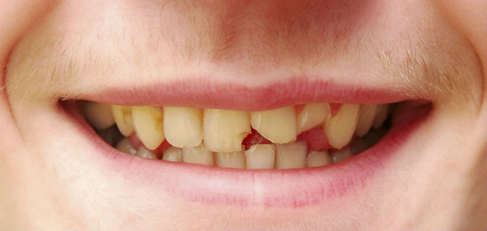 A close-up smile is topped with a peach-fuzz mustache and the teeth are stained, crooked, and broken.