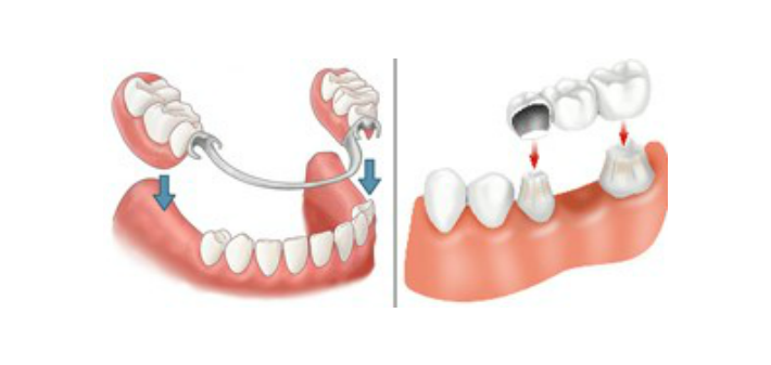 dentures versus bridges