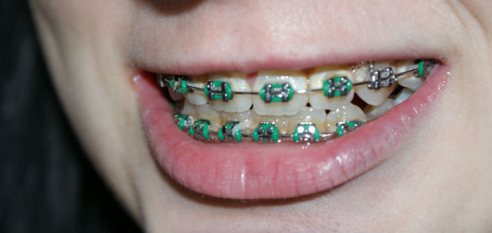 A smiling mouth exhibits a full set of braces with green rubber bands.