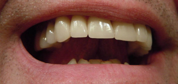 A mouth displays even, white teeth, none of which is obvious as a crown.