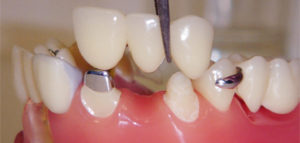 dental bridges from a Little Rock dentist