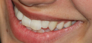 A smiling mouth displays a set of professionally whitened teeth.