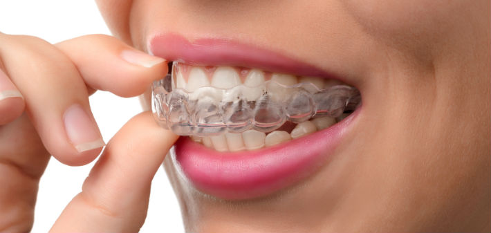 How long does Invisalign take to work? Here's what you can expect from an Invisalign dentist in Little Rock.