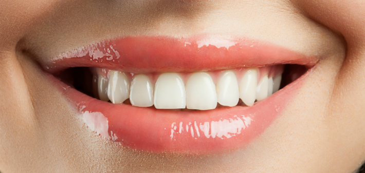 whiten veneers, dentures
