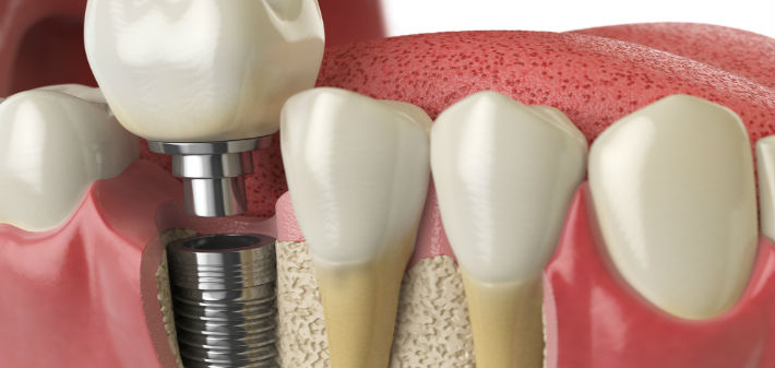 A mini dental implant is ready to to be placed between teeth.