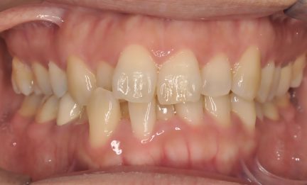 A close up of Patient Number One's Teeth shows they are very crooked and need orthodontia.