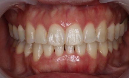 A close up of Patient Number One's Teeth shows they are very crooked and need orthodontia.