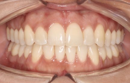 A close up of Patient Number Three's teeth show they are crooked, unevenly spaced, and set forward or back in the gumline.