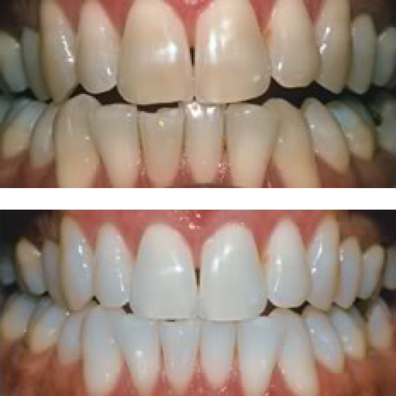 The top set of teeth are stained and yellow, while the bottom are white and smooth after a Perfecta Rev teeth whitening treatment.