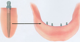 Mini Dental Implants AFD