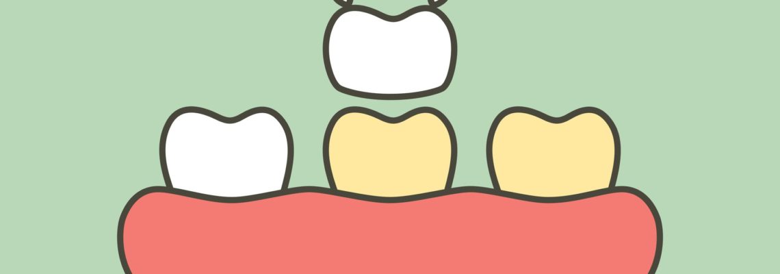 Veneers or Invisalign? These cartoon teeth are getting a veneer bonded to one tooth.