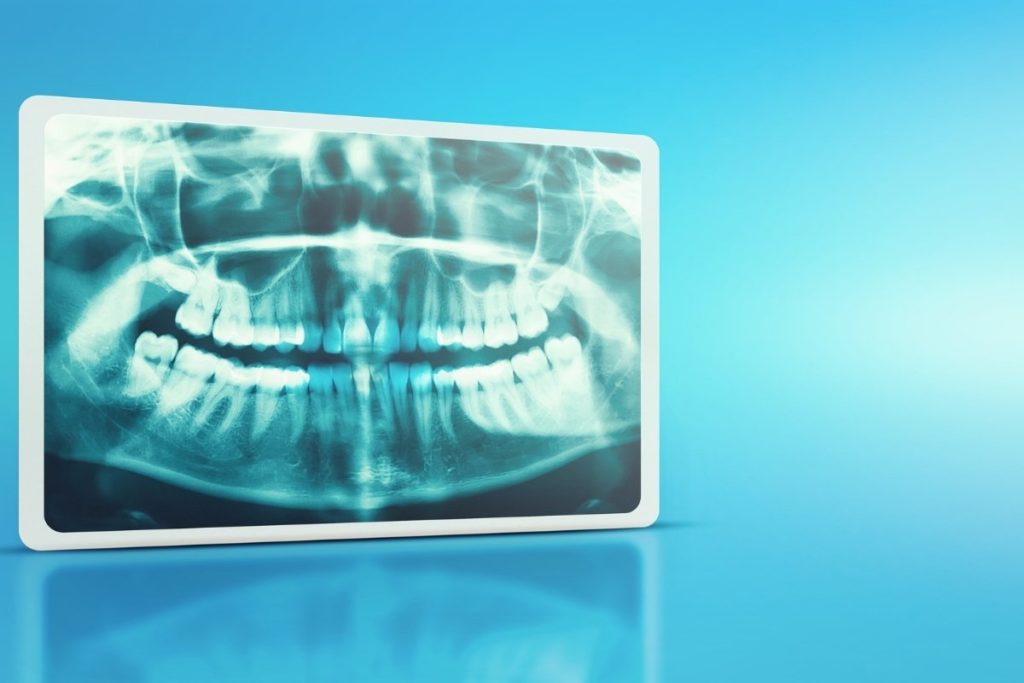 Wisdom Teeth Extraction in Adults and Teens What to Expect Wisdom Teeth Extraction in Adults and Teens What to Expect