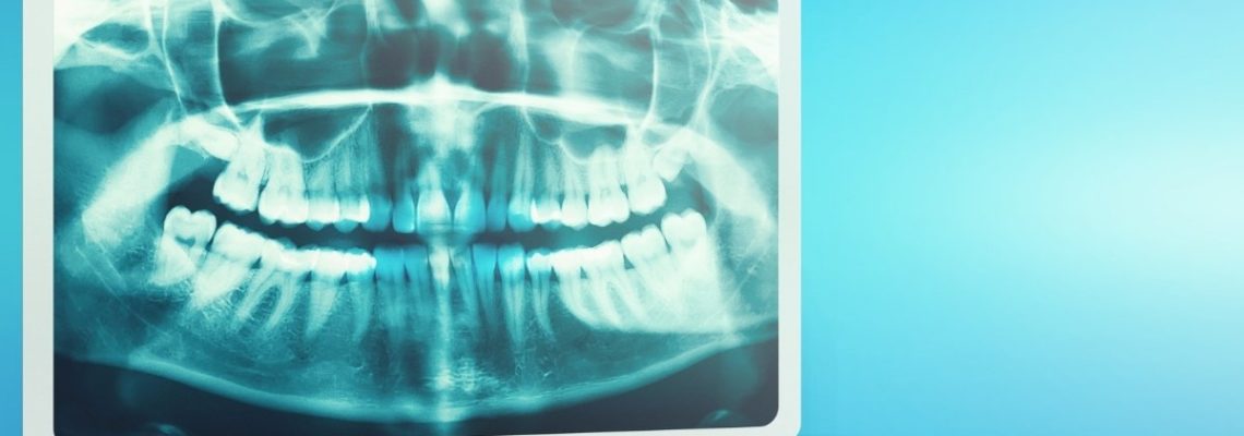 Wisdom Teeth Extraction in Adults and Teens | What to Expect