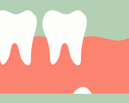 Are there Disadvantages of Removing Wisdom Teeth?