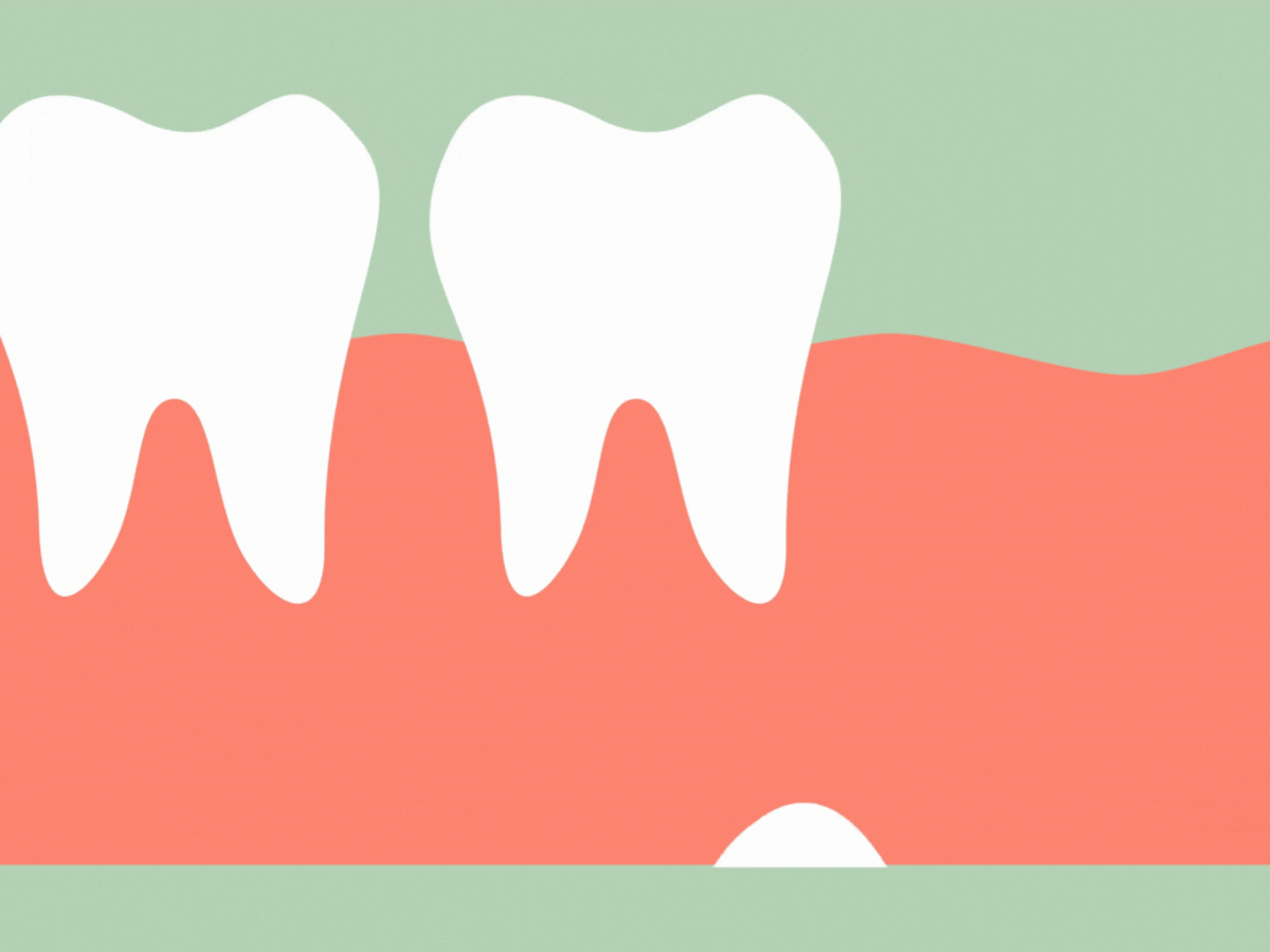 Are there Disadvantages of Removing Wisdom Teeth?