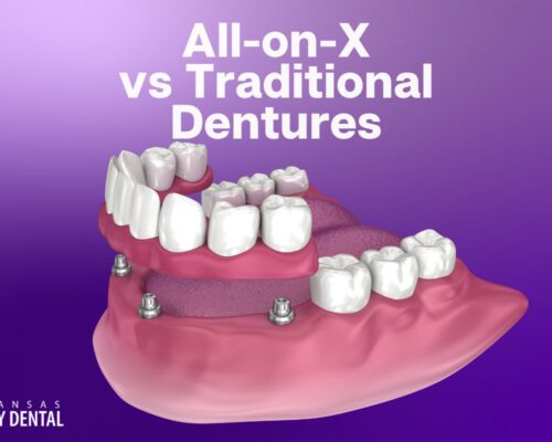 All-on-X vs Traditional Dentures: Which One is Right for You? cover