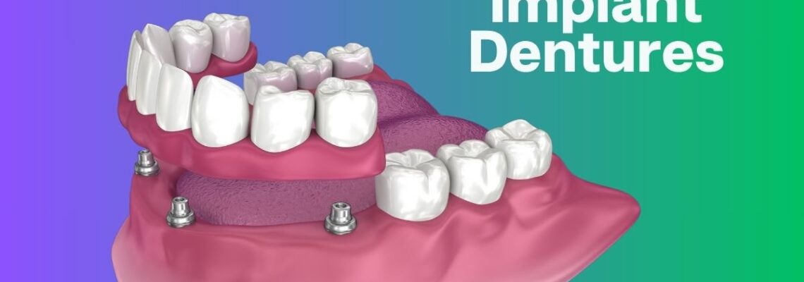 All-on-X Implants vs Traditional Dentures: What's Right for You? cover